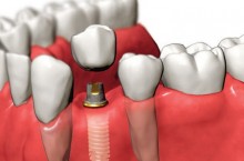 Возможна ли имплантация при полном отсутствии зубов?