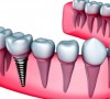 Чем отличается протезирование на имплантах от других способов?