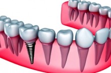 Какое протезирование зубов самое лучшее?